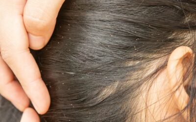 Comment savoir si on a des poux ?